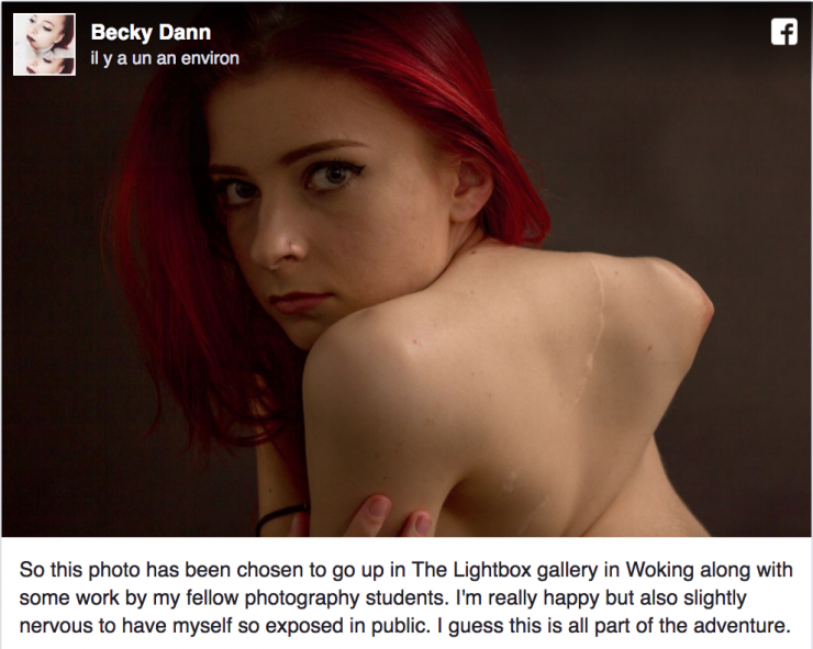 Illustration de l'article : Les médecins refusent de l'opérer à 9 ans, aujourd'hui, j'ai la chair de poule devant les photos de son corps.