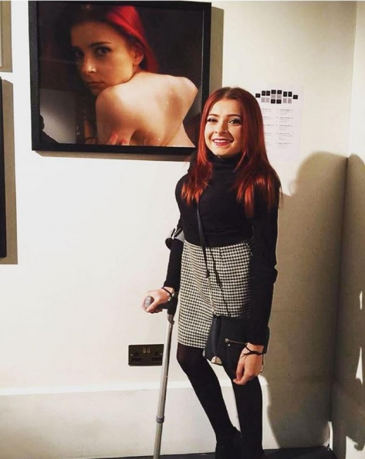 Illustration de l'article : Les médecins refusent de l'opérer à 9 ans, aujourd'hui, j'ai la chair de poule devant les photos de son corps.