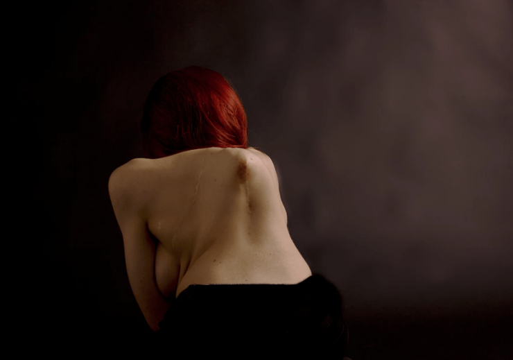 Illustration de l'article : Les médecins refusent de l'opérer à 9 ans, aujourd'hui, j'ai la chair de poule devant les photos de son corps.