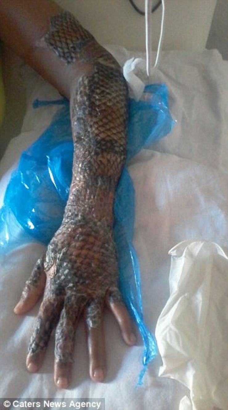 Illustration de l'article : Après avoir vécu ce brûlant cauchemar, c'est la première à recevoir ce traitement dans le monde!