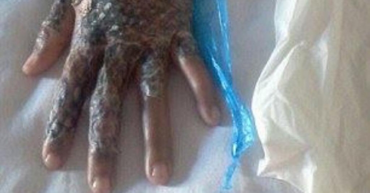 Illustration de l'article : Après avoir vécu ce brûlant cauchemar, c'est la première à recevoir ce traitement dans le monde!