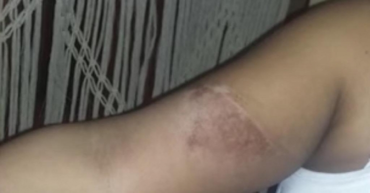 Illustration de l'article : Après avoir vécu ce brûlant cauchemar, c'est la première à recevoir ce traitement dans le monde!