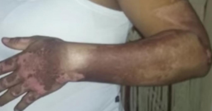 Illustration de l'article : Après avoir vécu ce brûlant cauchemar, c'est la première à recevoir ce traitement dans le monde!