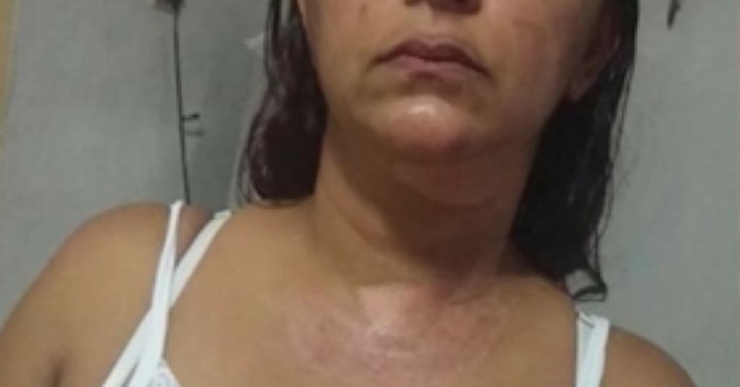 Illustration de l'article : Après avoir vécu ce brûlant cauchemar, c'est la première à recevoir ce traitement dans le monde!