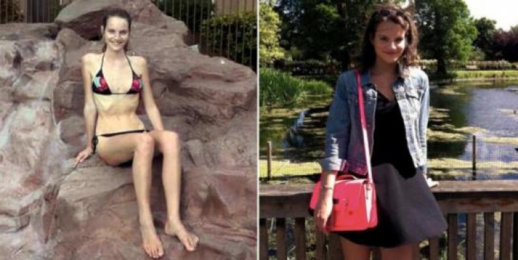 Illustration de l'article : « J’étais belle parce que j’étais maigre. C’était ma seule valeur » : Une ex mannequin raconte son combat contre l’anorexie !