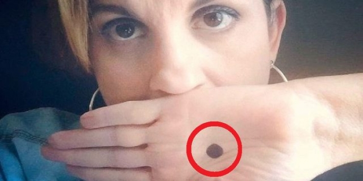 Illustration de l'article : Si une femme vous montre un point noir sur sa main, ne restez pas indiff&eacute;rent ! Ceci peut sauver des vies !