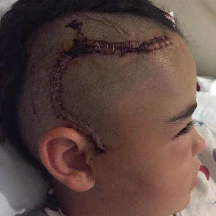 Illustration de l'article : Elle trouve que son fils agit bizarrement apr&egrave;s avoir jou&eacute; dehors. Deux jours plus tard, elle d&eacute;couvre ceci sur sa t&ecirc;te: 