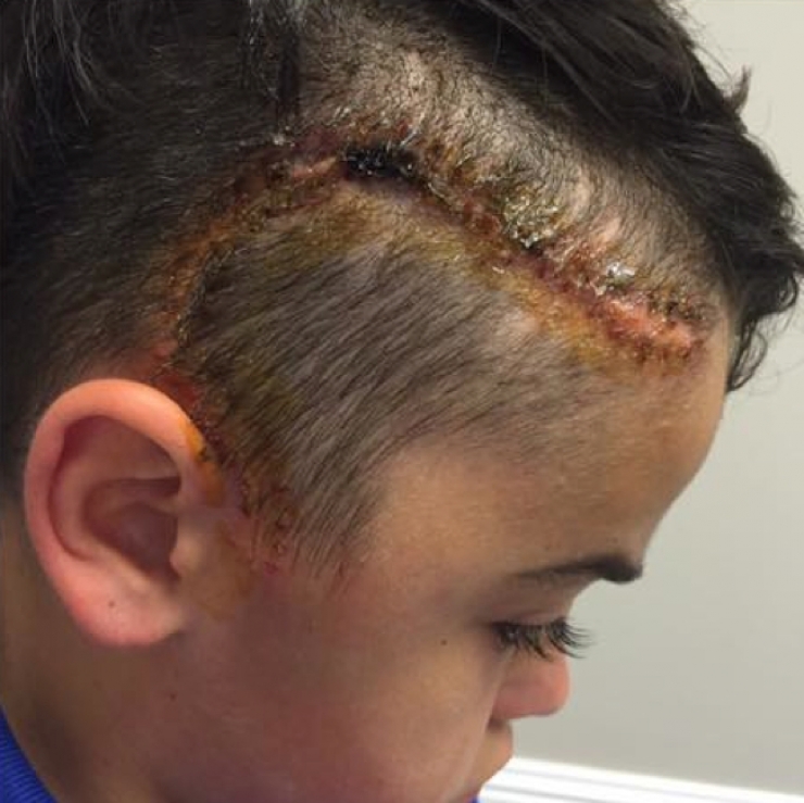 Illustration de l'article : Elle trouve que son fils agit bizarrement apr&egrave;s avoir jou&eacute; dehors. Deux jours plus tard, elle d&eacute;couvre ceci sur sa t&ecirc;te: 