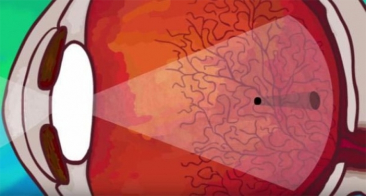 Illustration de l'article : Voici pourquoi il vous arrive parfois de voir des corps flottants qui viennent g&ecirc;ner votre vision&hellip; C&rsquo;est rassurant !