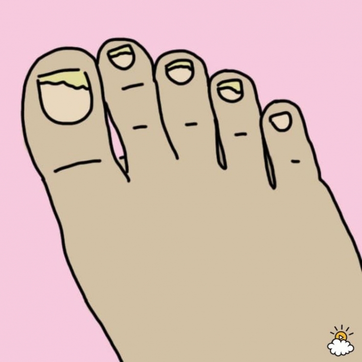 Illustration de l'article : Cette femme met ses pieds dans du Listerine, regardez bien le résultat après 30 minutes !