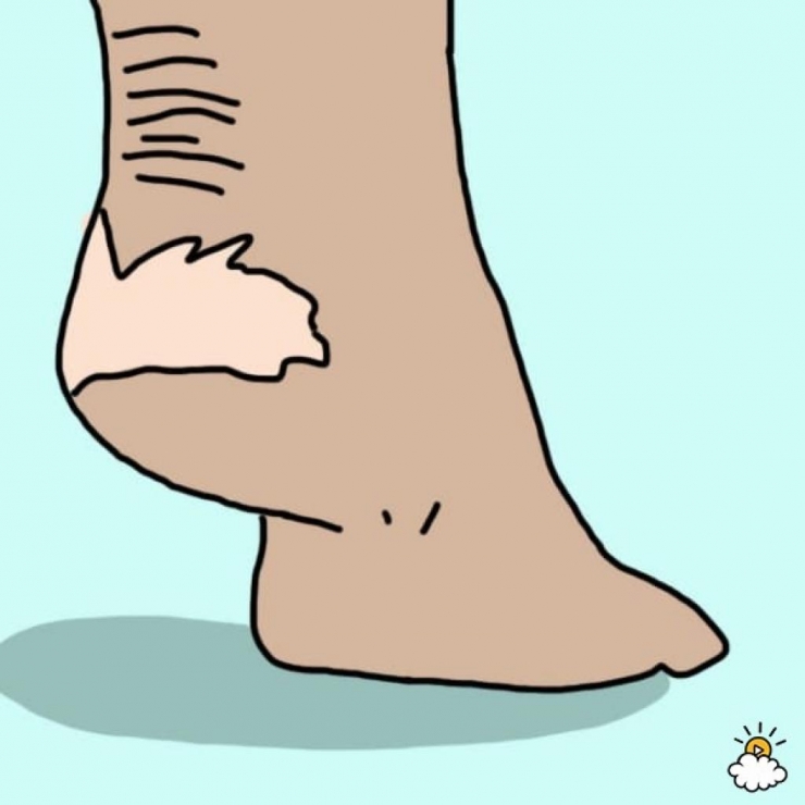 Illustration de l'article : Cette femme met ses pieds dans du Listerine, regardez bien le résultat après 30 minutes !