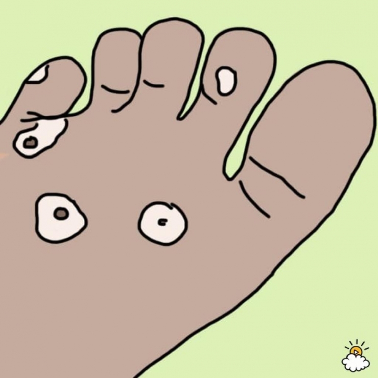 Illustration de l'article : Cette femme met ses pieds dans du Listerine, regardez bien le résultat après 30 minutes !