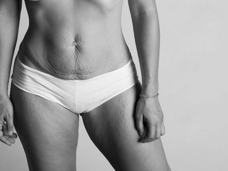 Illustration de l'article : Des clich&eacute;s qui montrent la r&eacute;alit&eacute; du corps apr&egrave;s l'accouchement. La beaut&eacute; sans artifices...