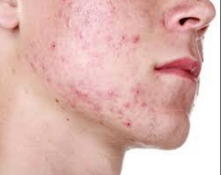 Illustration de l'article : Les bienfaits d'une tomate plac&eacute;e sur votre peau pendant une heure... Une excellente astuce !