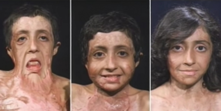 Illustration de l'article : À 9 ans, cette fillette a vécu un horrible calvaire… Mais une année plus tard, elle est méconnaissable !