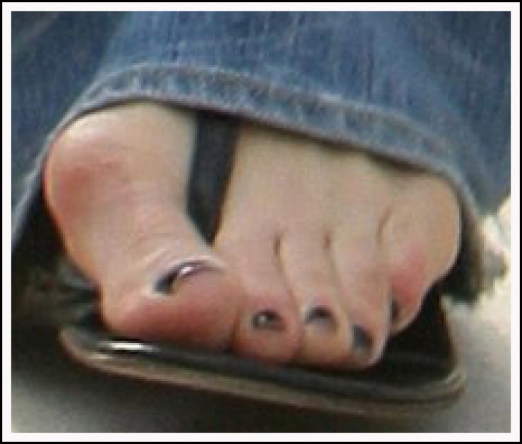 Illustration de l'article : Top 19 des plus moches photos de pieds... De quoi d&eacute;complexer !
