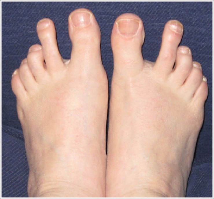 Illustration de l'article : Top 19 des plus moches photos de pieds... De quoi d&eacute;complexer !