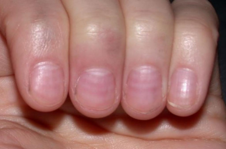 Illustration de l'article : L'état de vos ongles en dit long sur votre santé et il peut être révélateur de sérieuses maladies/carences !