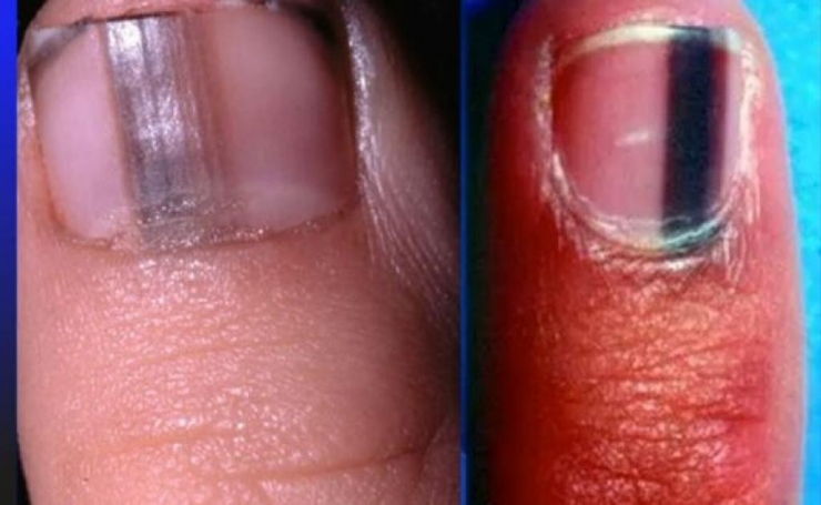 Illustration de l'article : L'état de vos ongles en dit long sur votre santé et il peut être révélateur de sérieuses maladies/carences !