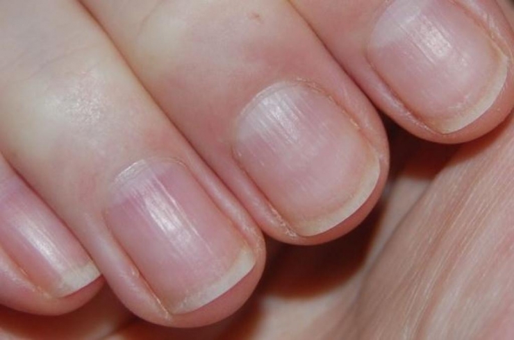 Illustration de l'article : L'état de vos ongles en dit long sur votre santé et il peut être révélateur de sérieuses maladies/carences !