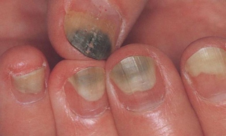 Illustration de l'article : L'état de vos ongles en dit long sur votre santé et il peut être révélateur de sérieuses maladies/carences !