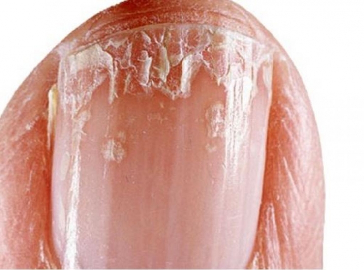 Illustration de l'article : L'état de vos ongles en dit long sur votre santé et il peut être révélateur de sérieuses maladies/carences !