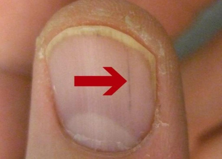 Illustration de l'article : L'état de vos ongles en dit long sur votre santé et il peut être révélateur de sérieuses maladies/carences !