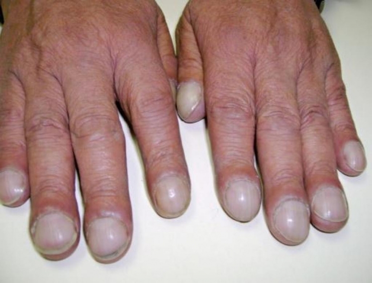 Illustration de l'article : L'état de vos ongles en dit long sur votre santé et il peut être révélateur de sérieuses maladies/carences !