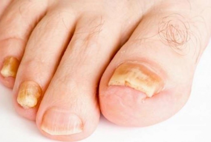 Illustration de l'article : L'état de vos ongles en dit long sur votre santé et il peut être révélateur de sérieuses maladies/carences !