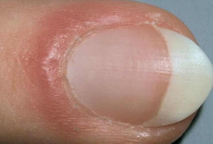 Illustration de l'article : L'état de vos ongles en dit long sur votre santé et il peut être révélateur de sérieuses maladies/carences !