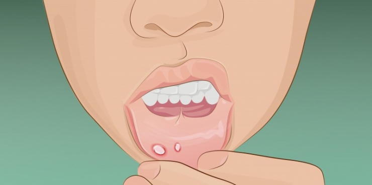 Illustration de l'article : 8 trucs pour faire disparaître vos boutons de fièvre en un jour.