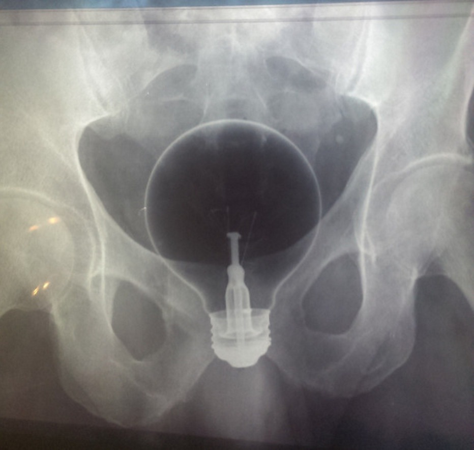 Illustration de l'article : Les docteurs dévoilent 17 objets glauques qu'ils ont dû retirer des parties génitales de leurs patients...