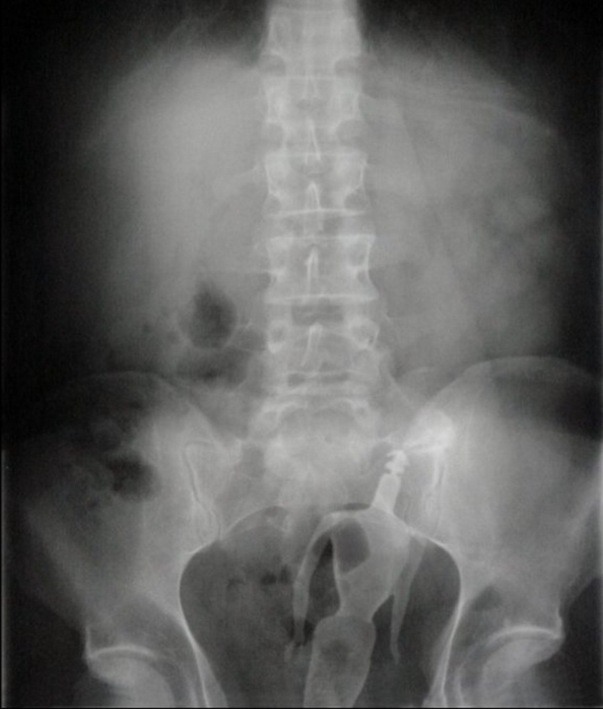 Illustration de l'article : Les docteurs dévoilent 17 objets glauques qu'ils ont dû retirer des parties génitales de leurs patients...