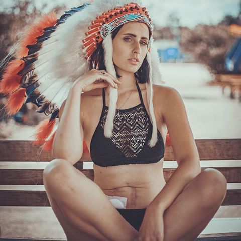 Illustration de l'article : On lui retire l'intestin à 16 ans, aujourd'hui les photos de son corps et de son projet touchent tout le monde!