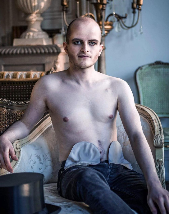 Illustration de l'article : On lui retire l'intestin à 16 ans, aujourd'hui les photos de son corps et de son projet touchent tout le monde!