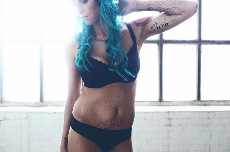 Illustration de l'article : On lui retire l'intestin à 16 ans, aujourd'hui les photos de son corps et de son projet touchent tout le monde!