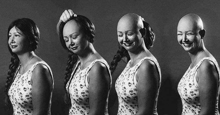 Illustration de l'article : On lui retire l'intestin à 16 ans, aujourd'hui les photos de son corps et de son projet touchent tout le monde!