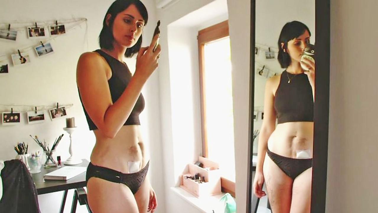 Illustration de l'article : On lui retire l'intestin à 16 ans, aujourd'hui les photos de son corps et de son projet touchent tout le monde!