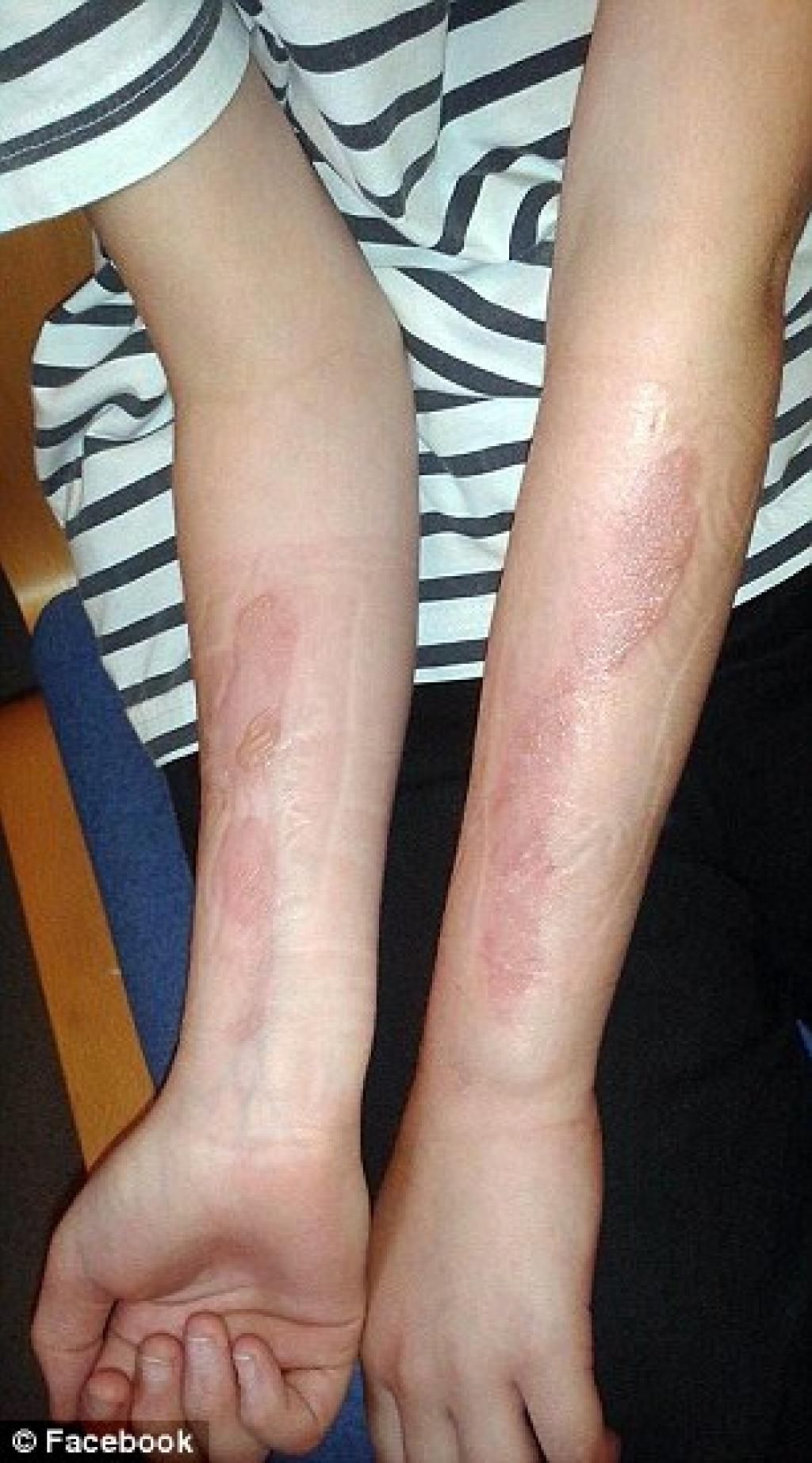 Illustration de l'article : Encore un d&eacute;fi stupide chez les jeunes, et avec de terribles blessures corporelles !