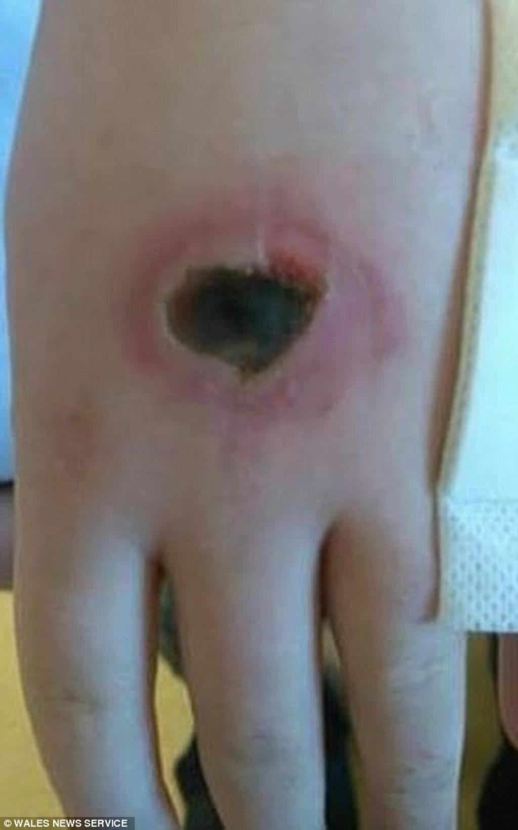 Illustration de l'article : Encore un d&eacute;fi stupide chez les jeunes, et avec de terribles blessures corporelles !