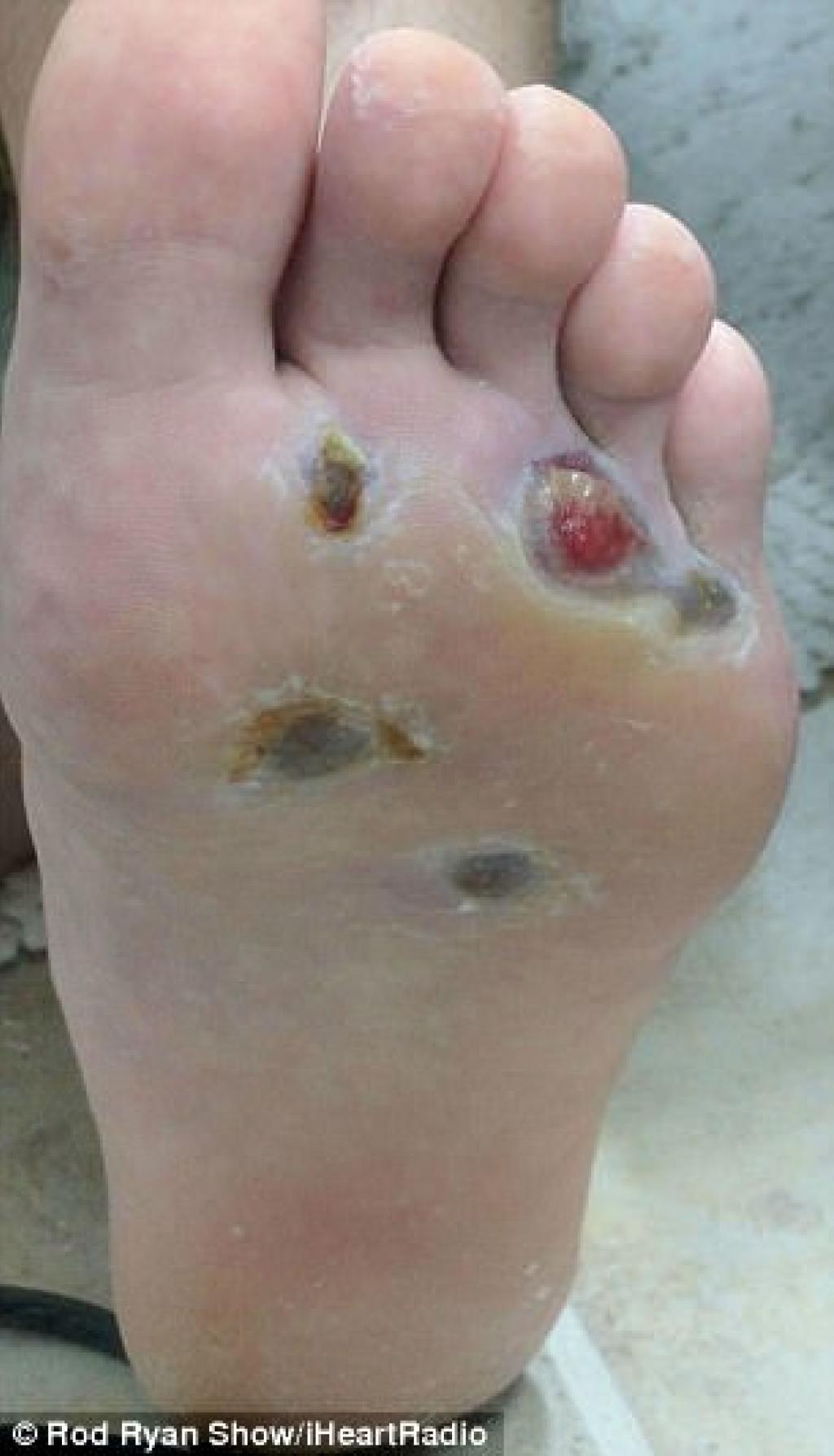 Illustration de l'article : Attention À Ce Geste Qui Lui A Valu Une Horrible Infection Des Pieds! Trop De Gens Le Font!