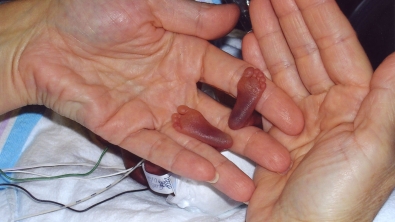 Illustration : "Les docteurs ne donnaient aucune chance à ce foetus de 21 semaines...Et pourtant !"
