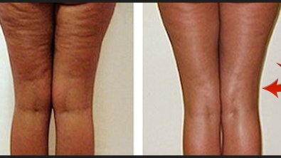Illustration : Pour combattre la cellulite, elle utilise un produit qu'on a tous à la maison... 