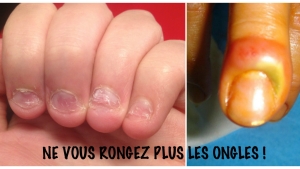 Illustration : "Après avoir lu cet article vous ne vous rongerez JAMAIS plus les ongles ! Les risques sont dégoûtants.. "