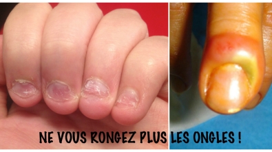 Illustration : Après avoir lu cet article vous ne vous rongerez JAMAIS plus les ongles ! Les risques sont dégoûtants.. 