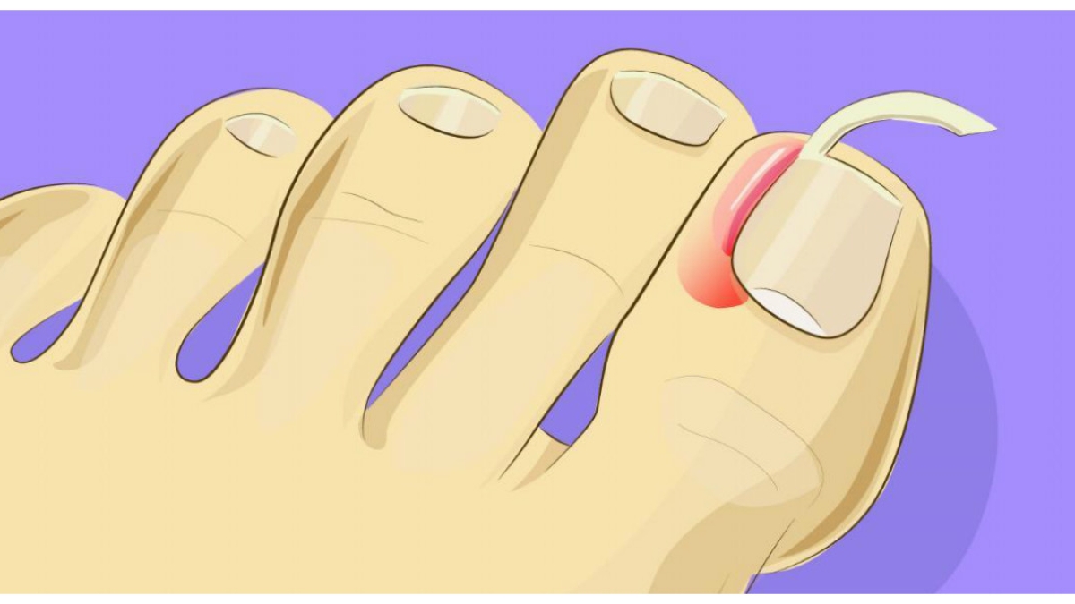 Plus besoin de se faire opérer pour soigner un ongle incarné ! On vous