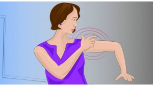 Illustration : "Les femmes doivent absolument faire attention à ces 8 symptômes d’AVC !"
