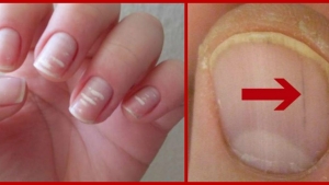 Illustration : "L'état de vos ongles en dit long sur votre santé et il peut être révélateur de sérieuses maladies/carences !"