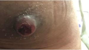 Image illustrant l'article Son bouton sur les fesses est énorme, l'infirmière le perce et c'est inimaginable de voir ce qui en sort...
