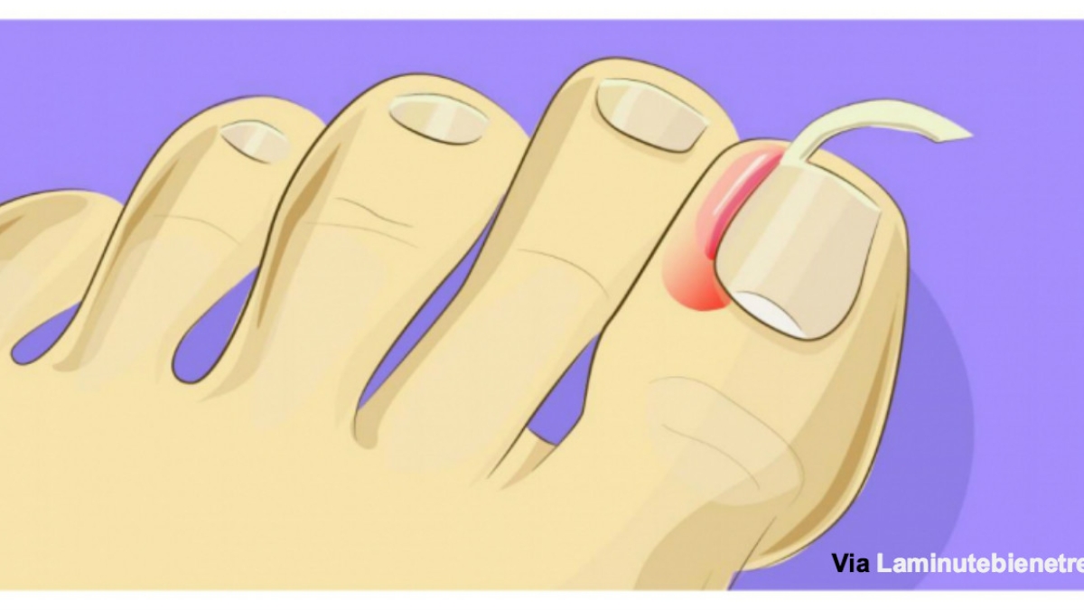 Non, vous n'avez plus besoin d'une opération pour un ongle incarné